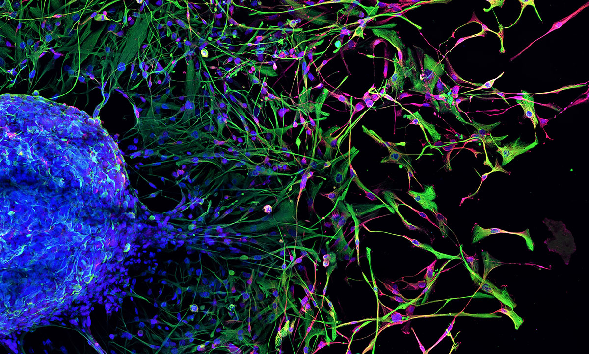 Des cellules souches issues d’une tumeur cérébrale (en bleu à gauche) migrent et se différencient en neurones (en vert et rouge à droite). © Caroline DELMAS / Laetitia LIGAT / CRCT / CNRS Images