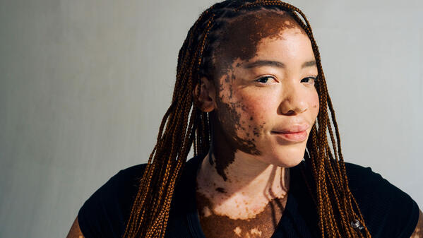 Une jeune femme ayant un vitiligo, maladie auto-immune.