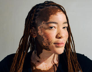Une jeune femme ayant un vitiligo, maladie auto-immune.