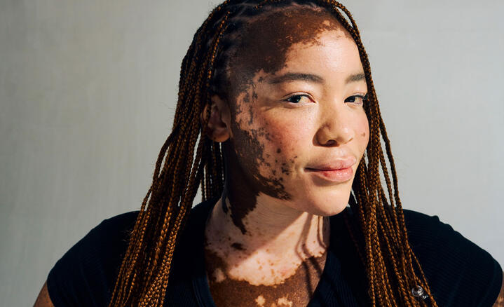 Une jeune femme ayant un vitiligo, maladie auto-immune.