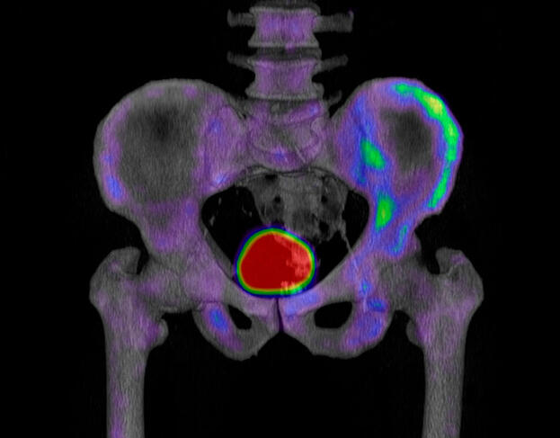 ©Centre Jean-Perrin / Science Photo Library Metastatic prostate cancer © Centre Jean-Perrin / Science Photo Library