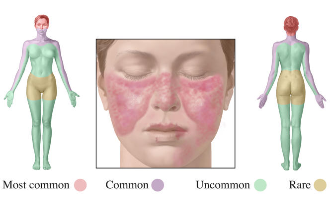 Illustration sur le Lupus