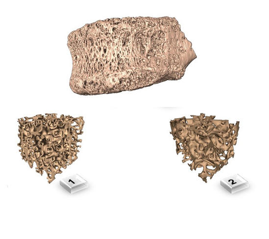 Reconstruction 3D d'une 3ème vertèbre lombaire présentant des signes d'infection tuberculeuse