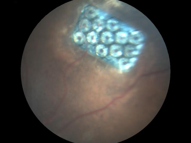 Rétine artificielle implantée dans l’œil d’un rat