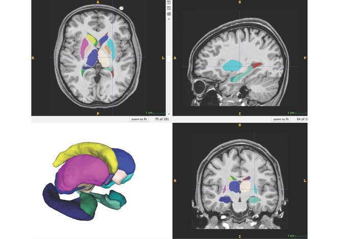 Segmentation et représentation 3D des structures sous-corticales par volBrain