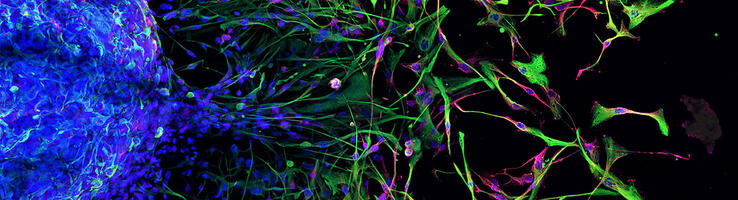 Des cellules souches issues d’une tumeur cérébrale (en bleu à gauche) migrent et se différencient en neurones (en vert et rouge à droite). © Caroline DELMAS / Laetitia LIGAT / CRCT / CNRS Images