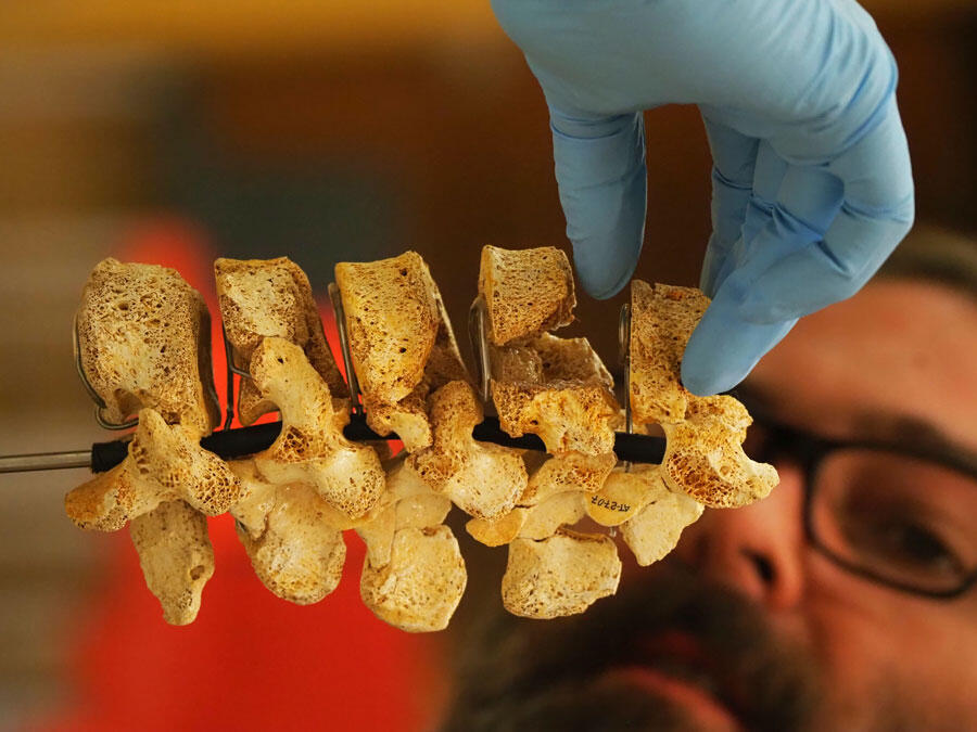 Une main gantée assemble des vertèbres lombaires.