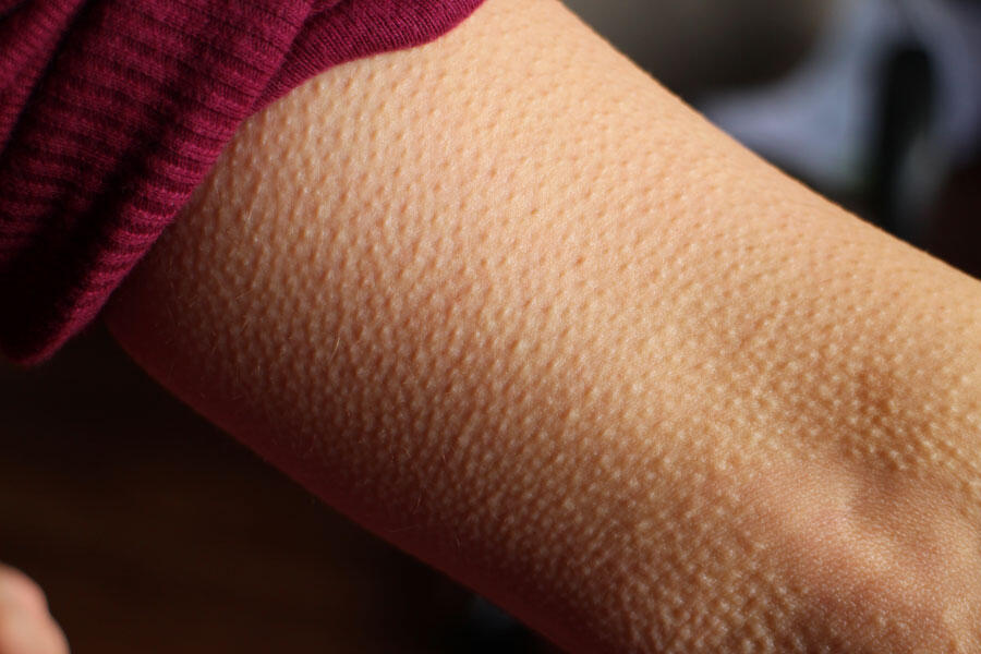 Gros plan sur la peau d’un bras, juste au-dessus du coude, avec l'effet chair de poule bien visible