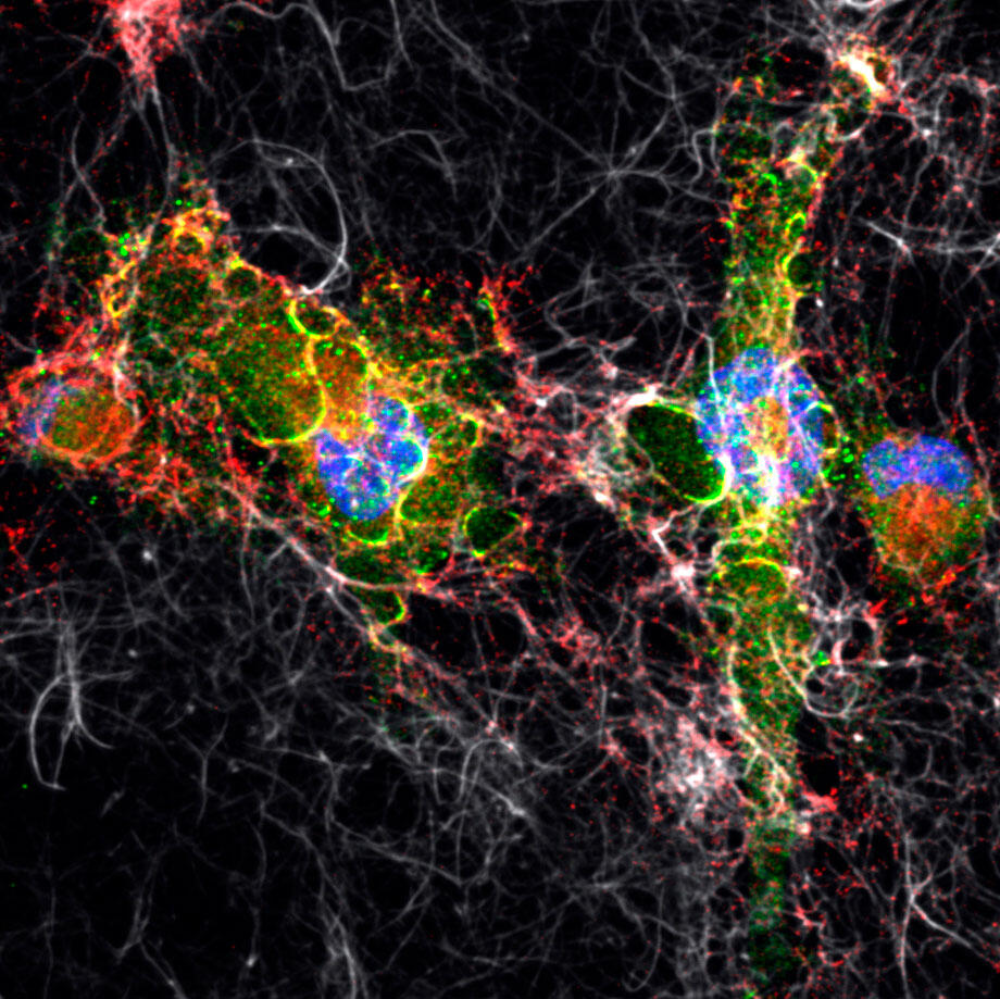 Les invadopodes sont des structures spécialisées des cellules cancéreuses impliqués dans la dégradation des fibres