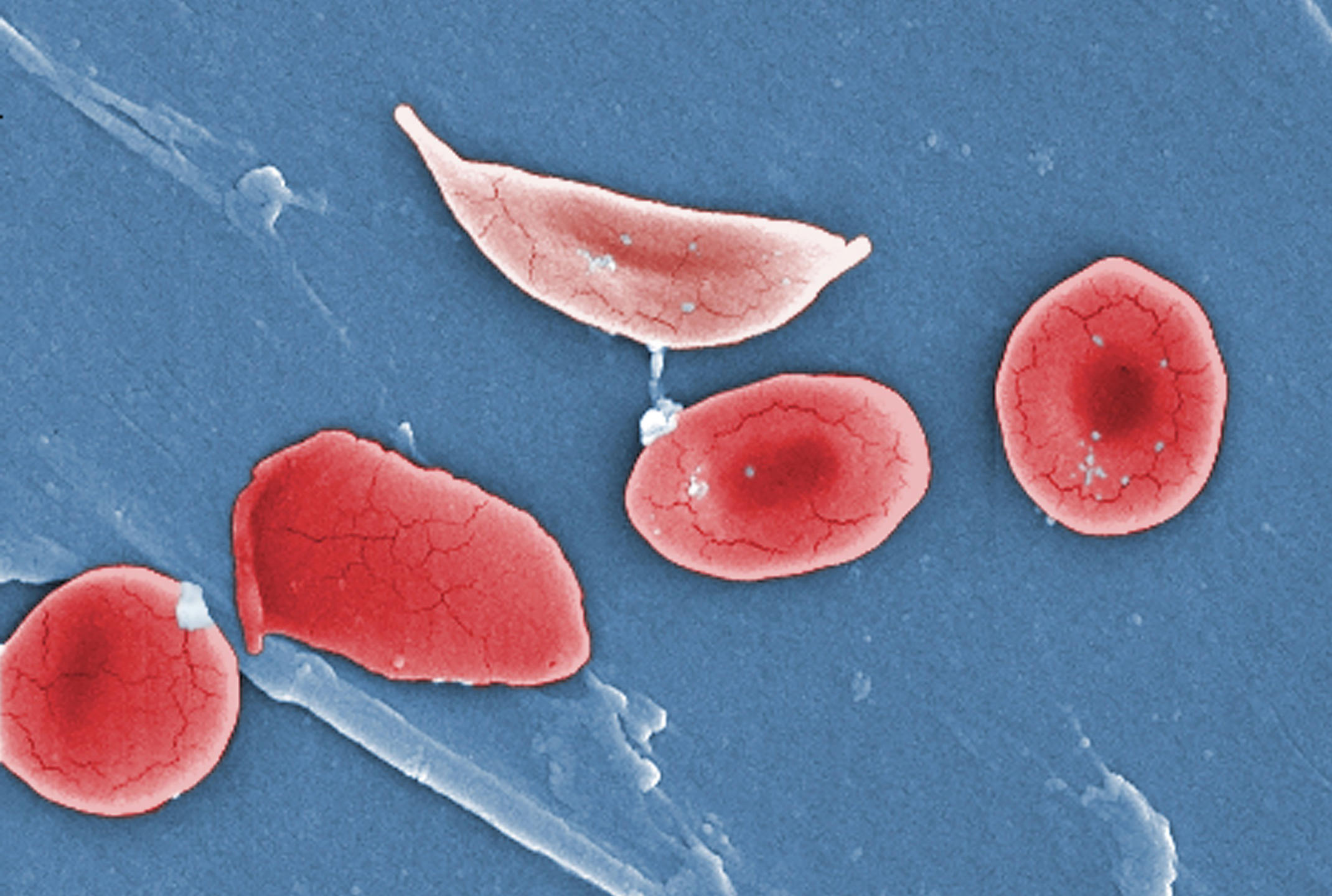 Globule rouge déformé par la drépanocytose