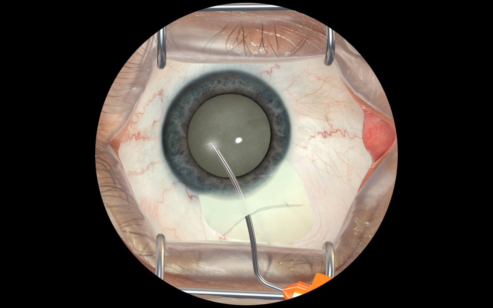 Simulation de la chirurgie de la cataracte.