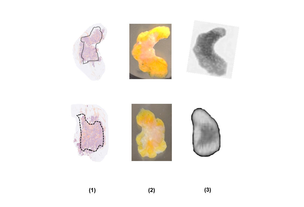 Echantillons de tissu mammaire humain vus après traitement avec une coloration histopathologique (I) révélant les régions cancéreuses (entourées de pointillés)  , à l’œil nu (II) et avec une caméra terahertz (III).