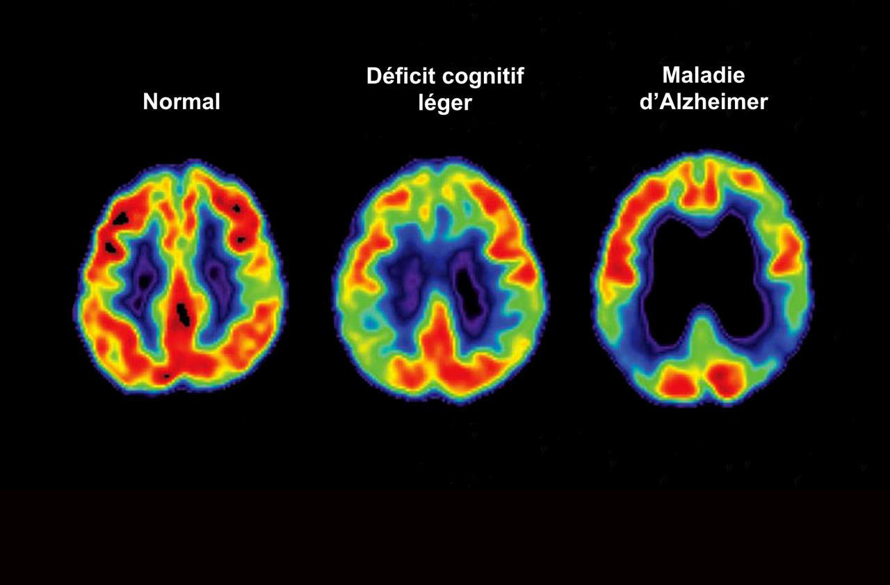 De nouveaux outils contre Alzheimer