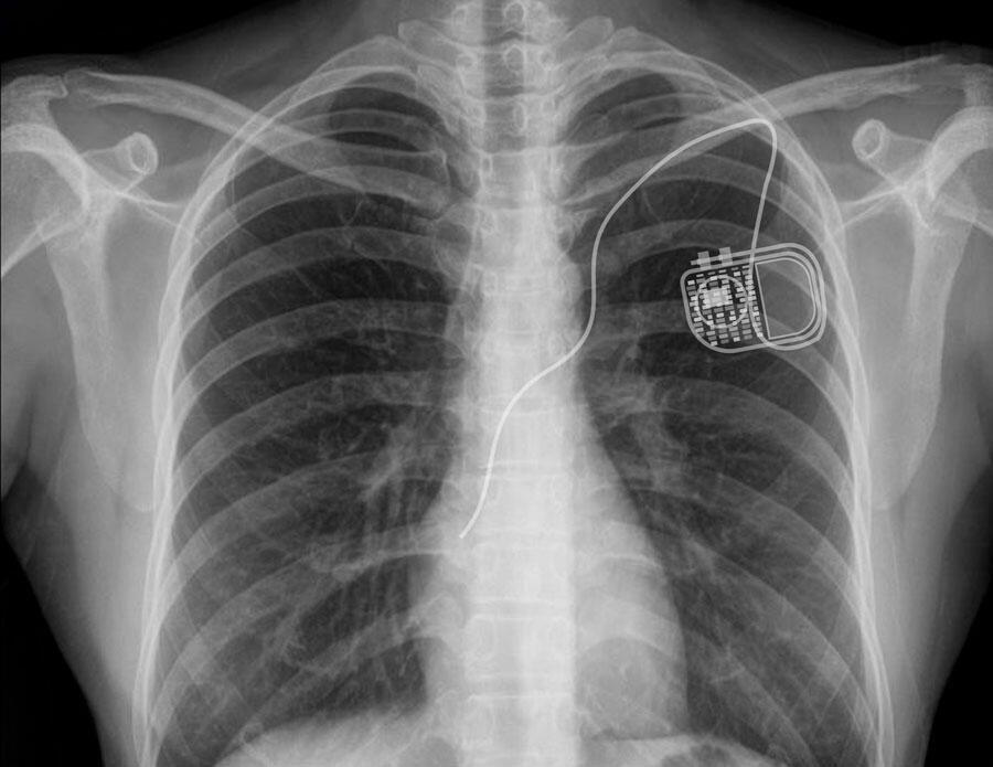 Radiographie d’un thorax montrant la taille et l’emplacement d’un pacemaker, sous la clavicule gauche