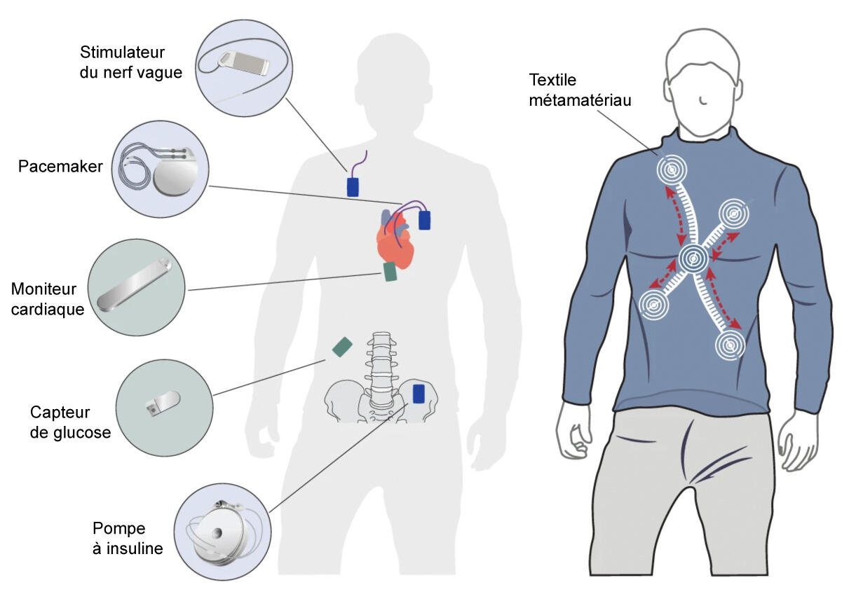 schéma illustrant quelques implants et leur localisation dans le corps humain