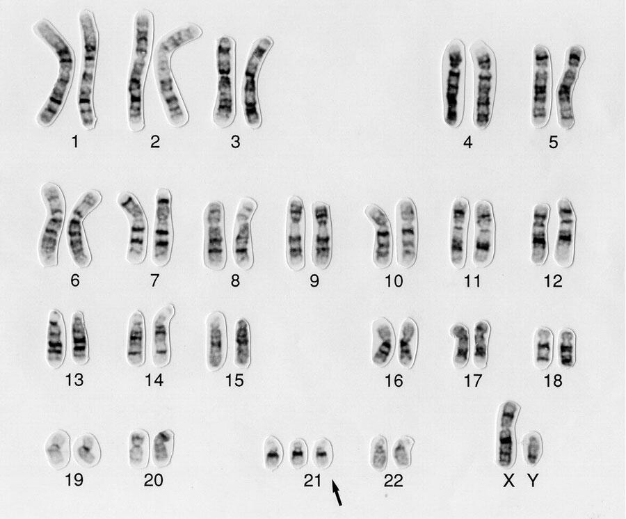Caryotype de chromosomes, rangés par paire. La 21e paire a un chromosome surnuméraire
