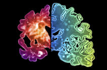 Image d'un hémisphère cérébral atteint d'Alzheimer et d'un hémisphère sain.