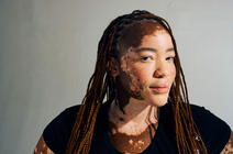 Une jeune femme ayant un vitiligo, maladie auto-immune.