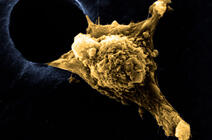 Image de microscopie d’une cellule métastasique et ses pseudopodes