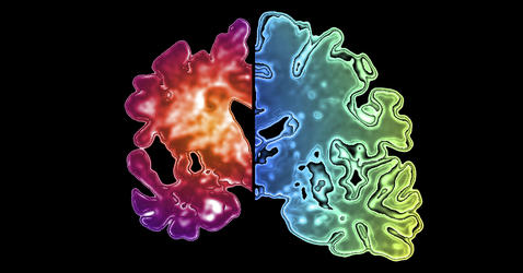 Image d'un hémisphère cérébral atteint d'Alzheimer et d'un hémisphère sain.