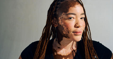 Une jeune femme ayant un vitiligo, maladie auto-immune.