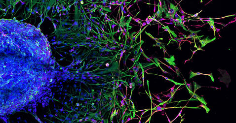 glioblastome © Caroline Delmas / Laetitia Ligat / CRCT / CNRS Images 