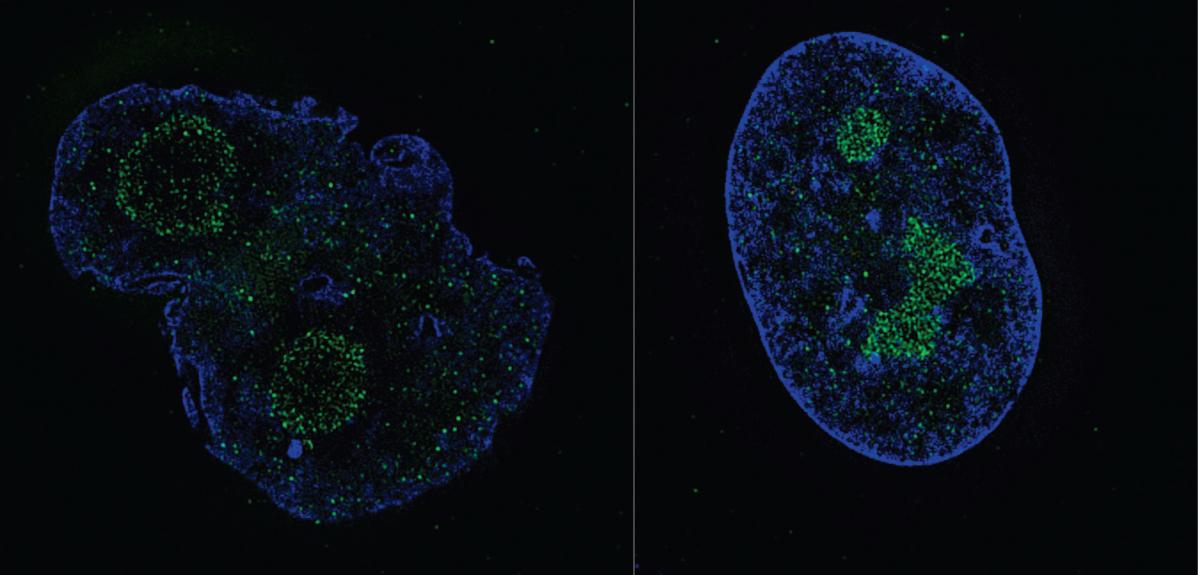  D. LARRIEU A gauche, un noyau de cellule dform. A droite, un noyau normal.