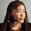 Une jeune femme ayant un vitiligo, maladie auto-immune.